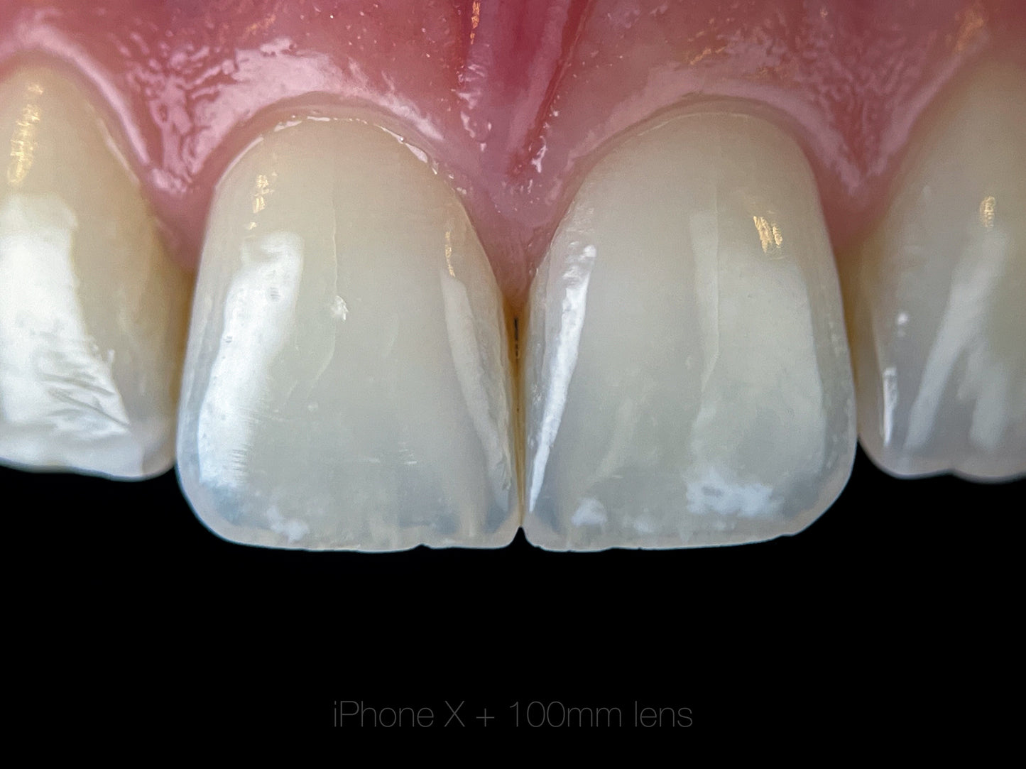 Lente Macro 100mm para telemóvel